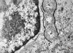 M,33y. | blood - hairy cell leukemia- ribosome-lamella complexin tricholeukocyte M,33y. | blood - hairy cell leukemia- ribosome-lamella complexin tricholeukocyte